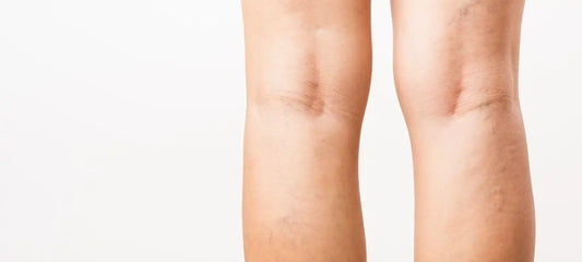 Cellulite an den Waden: So werden Sie die Orangenhaut los